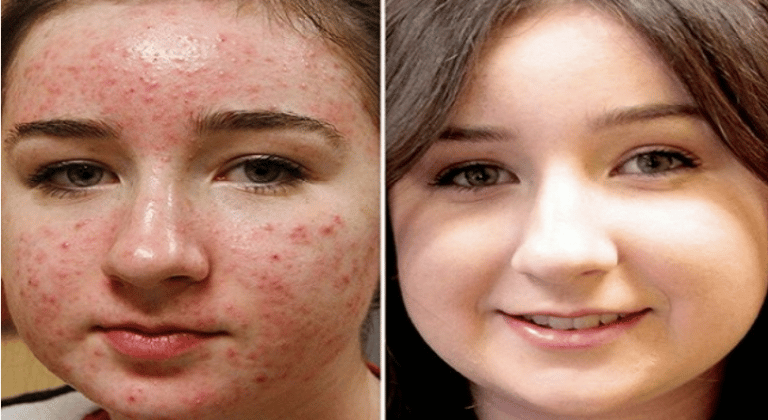 How to get rid of acne forever